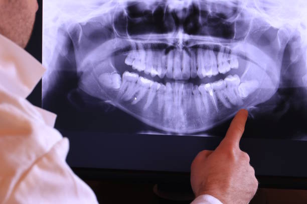 Best Emergency Tooth Extraction in Linthicum, MD