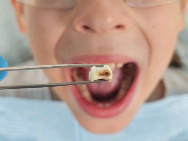 Best Emergency Dental Care for Broken or Chipped Teeth in Linthicum, MD